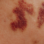 Nanda & Associate Lawyers Canada - Bruised skin due to an injury