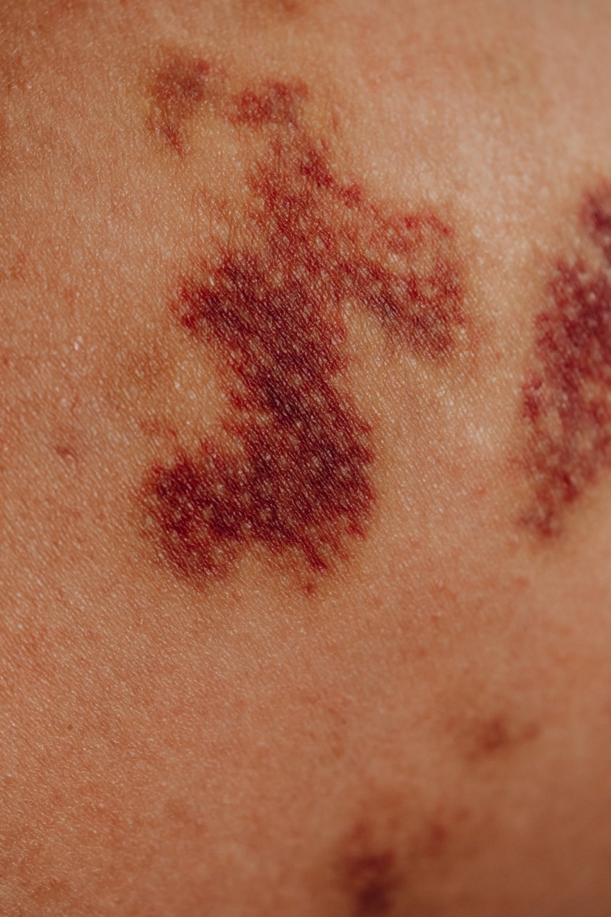 Nanda & Associate Lawyers Canada - Bruised skin due to an injury