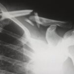 Nanda & Associate Lawyers Canada - X-Ray of a broken bone