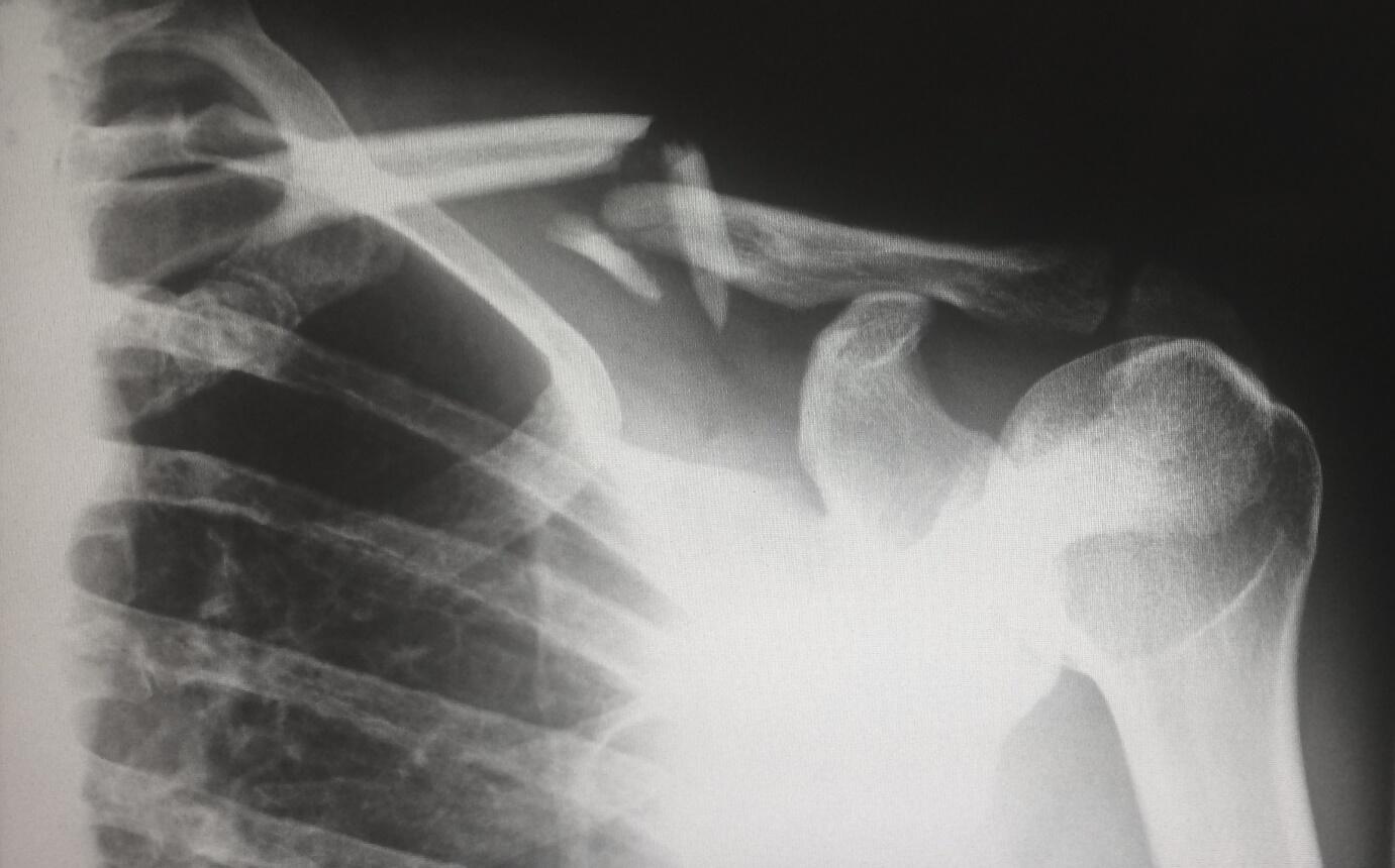 Nanda & Associate Lawyers Canada - X-Ray of a broken bone